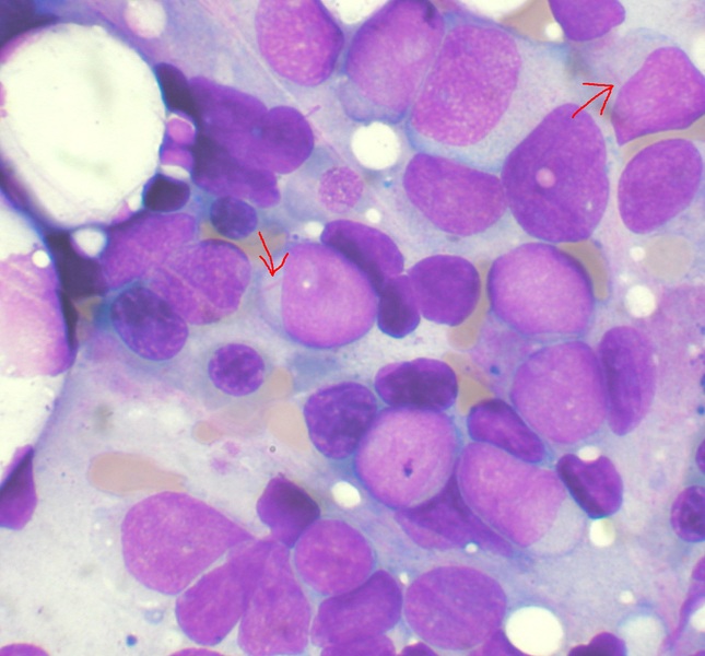 Acute myeloid leukemia 1