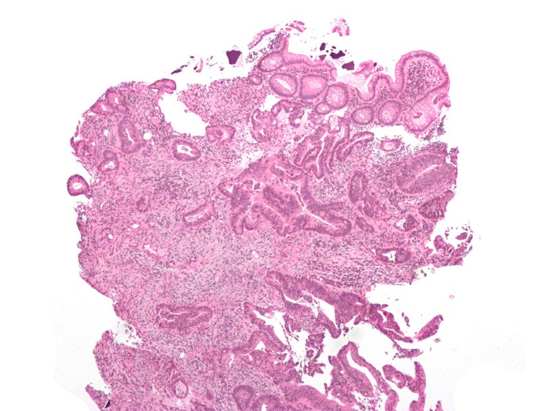 Cecal-adenocarcinoma