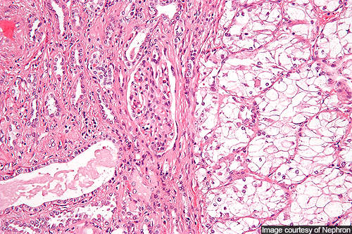 Axitinib Treatment for Advanced Renal Cell Carcinoma