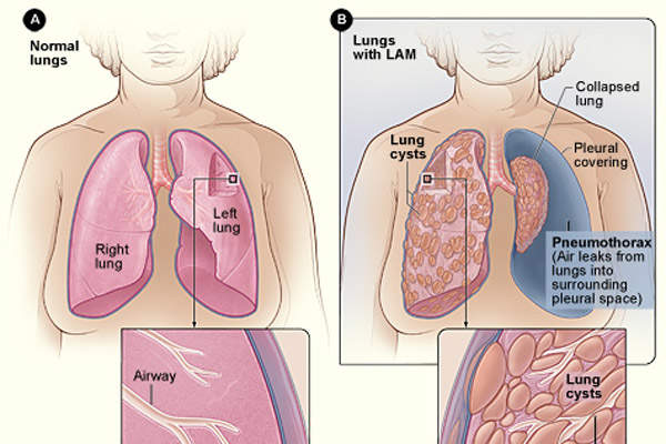 Rapamune (sirolimus) for the Treatment of Lymphangioleiomyomatosis (LAM