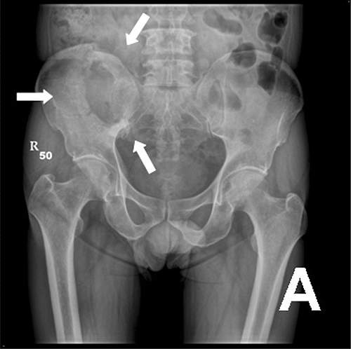 Prostate cancer in bones