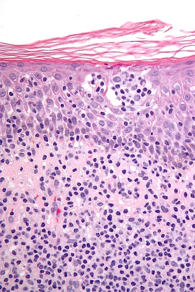 cutaneous T-cell lymphoma