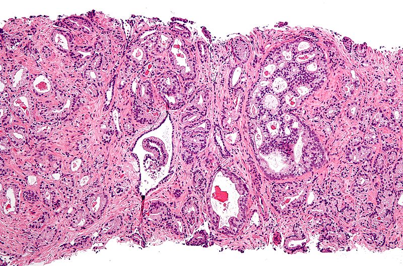 Micrograph of prostate adenocarcinoma, acinar type, the most common type of prostate cancer.