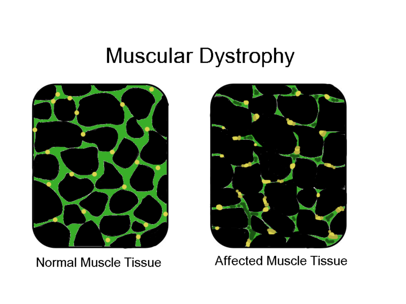 MuscularDystrophy
