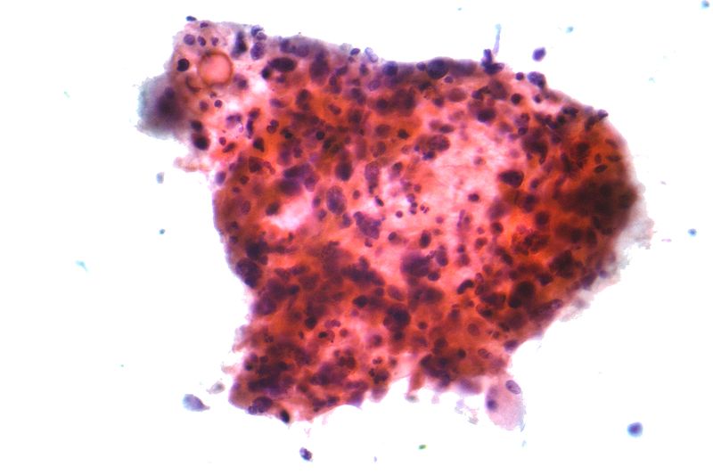 Squamous carcinoma lung 2 cytology