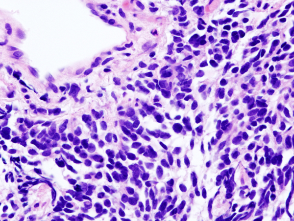 small cell carcinoma of the lung